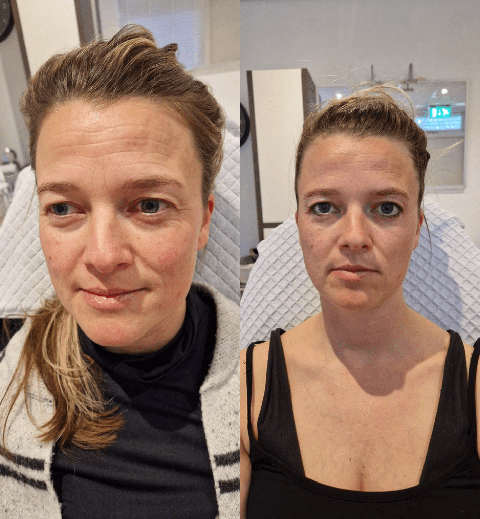 Forever young lift Kuur