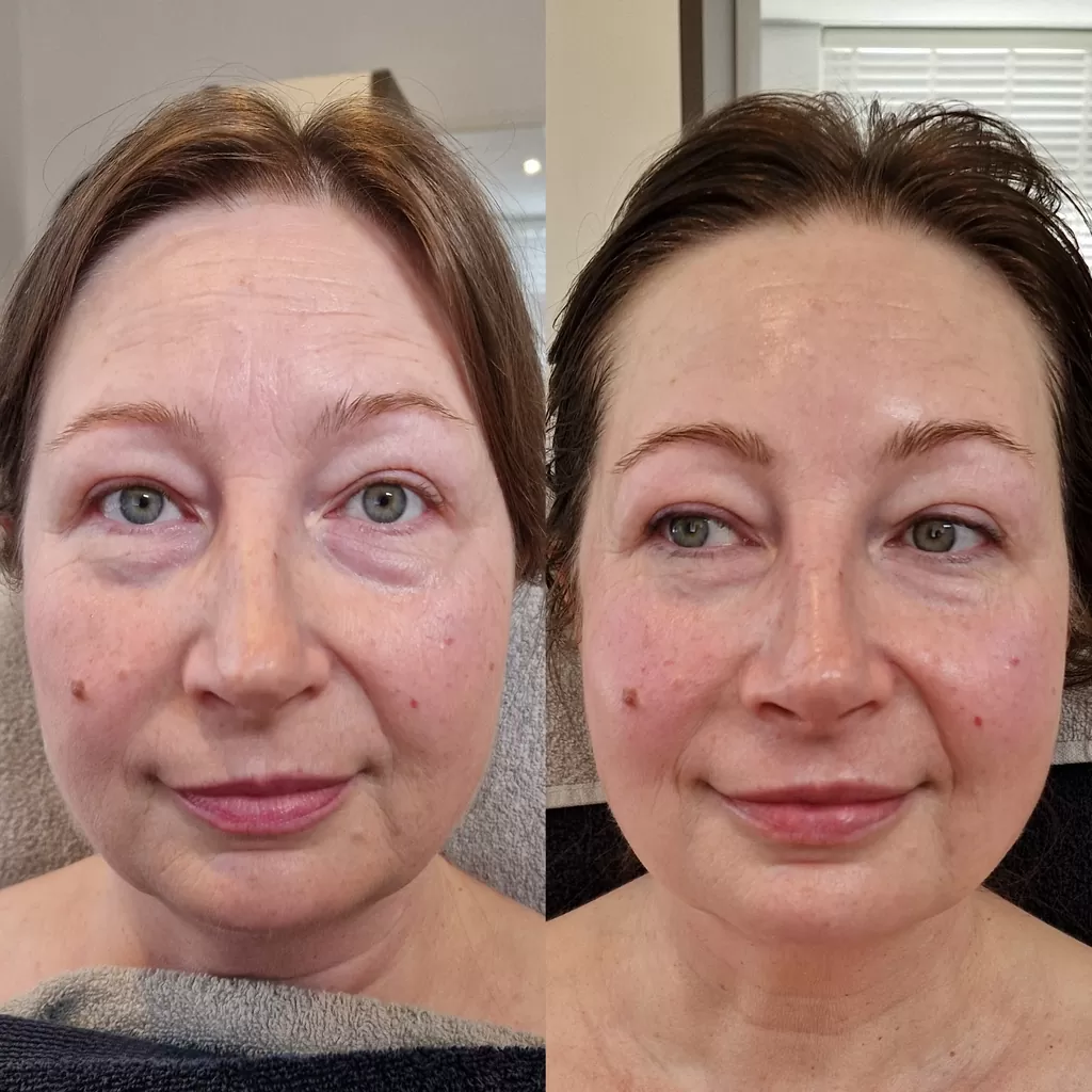 Forever young lift plus kuur